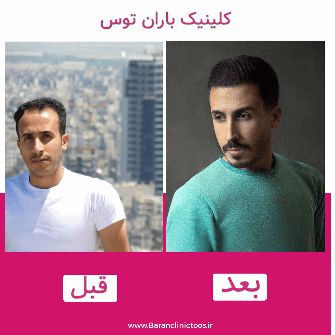 قبل و بعد کاشت مو